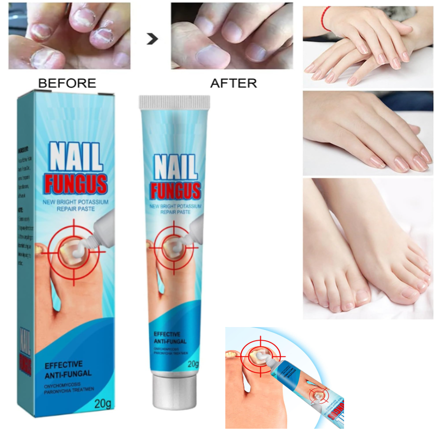 Crema de uñas tratamiento para hongos
