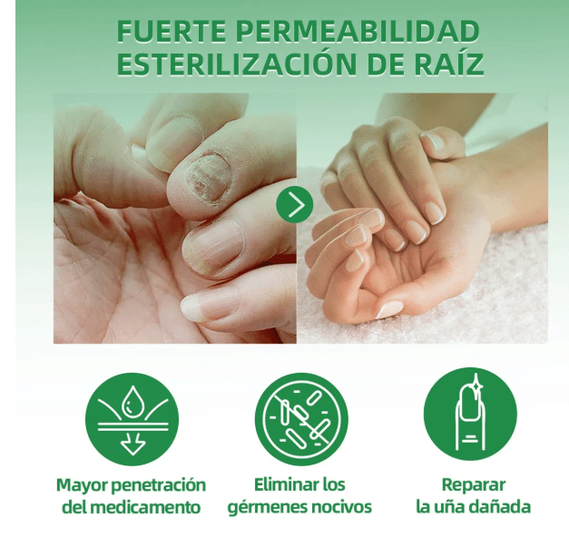 Gotas para Hongos Fungus – ECOM-0007