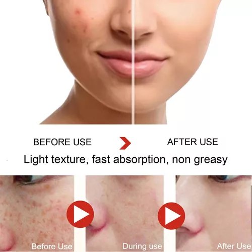 Crema Removedora Pecas rostro y cuerpo