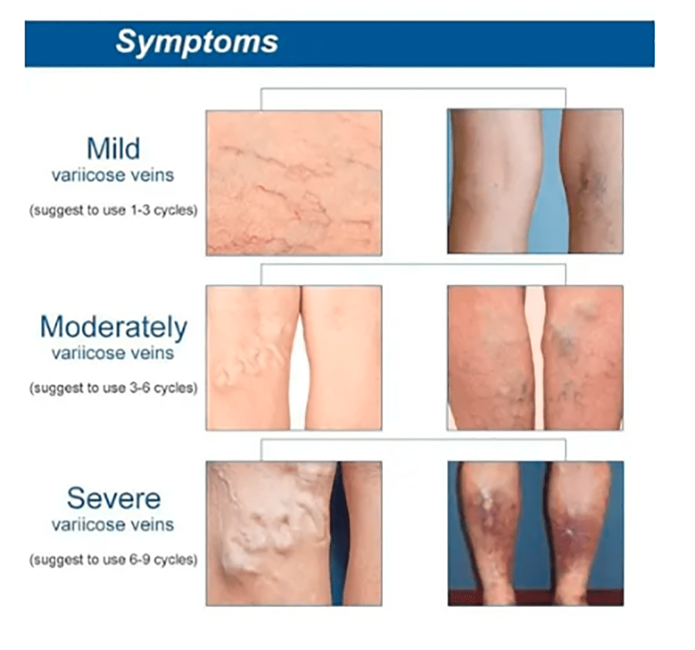 30 Parches de Varices para Circulacion