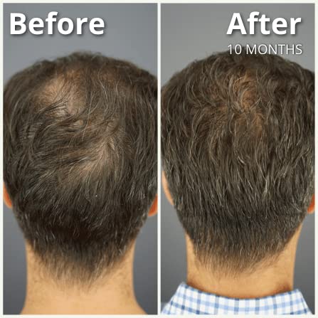 Dr.UGro Gashee Suplemento para el crecimiento del cabello para hombres y mujeres vitaminas para el cabello más grueso y fuerte. Promueve el