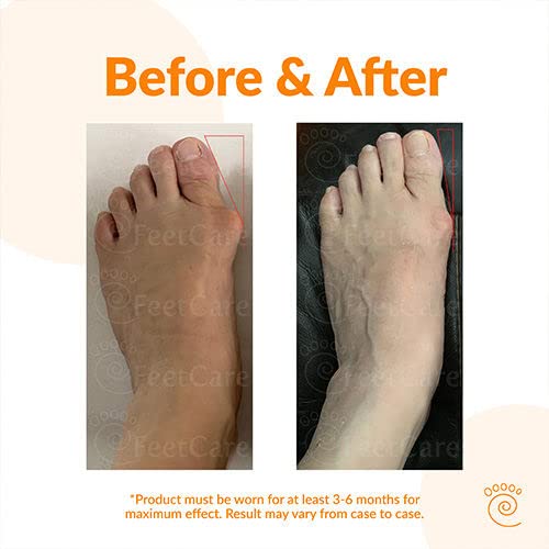 FeetCare Corrector de juanetes ultrafino  Funda para juanetes y alisadora  Diseño en Singapur fabricado en Japón (XS, derecho)