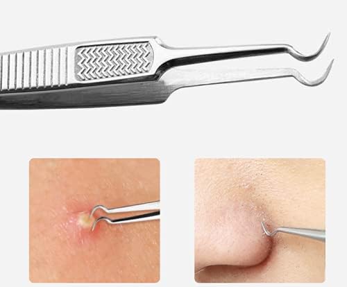 WOIWO Pinzas de acero inoxidable de doble extremo para el acné, pinza para el acné, herramienta de belleza para el codo, espinilla, 2 uds