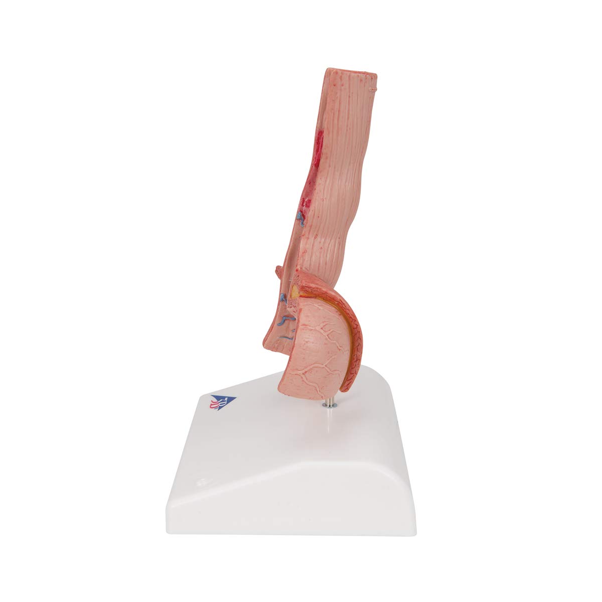 3B Scientific K18 Enfermedades del esófago – 3B Smart Anatomy