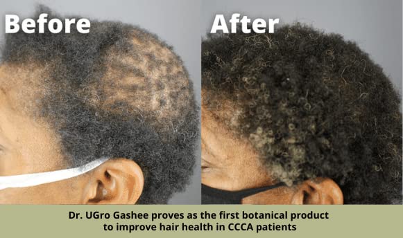 Dr.UGro Gashee Suplemento para el crecimiento del cabello para hombres y mujeres vitaminas para el cabello más grueso y fuerte. Promueve el