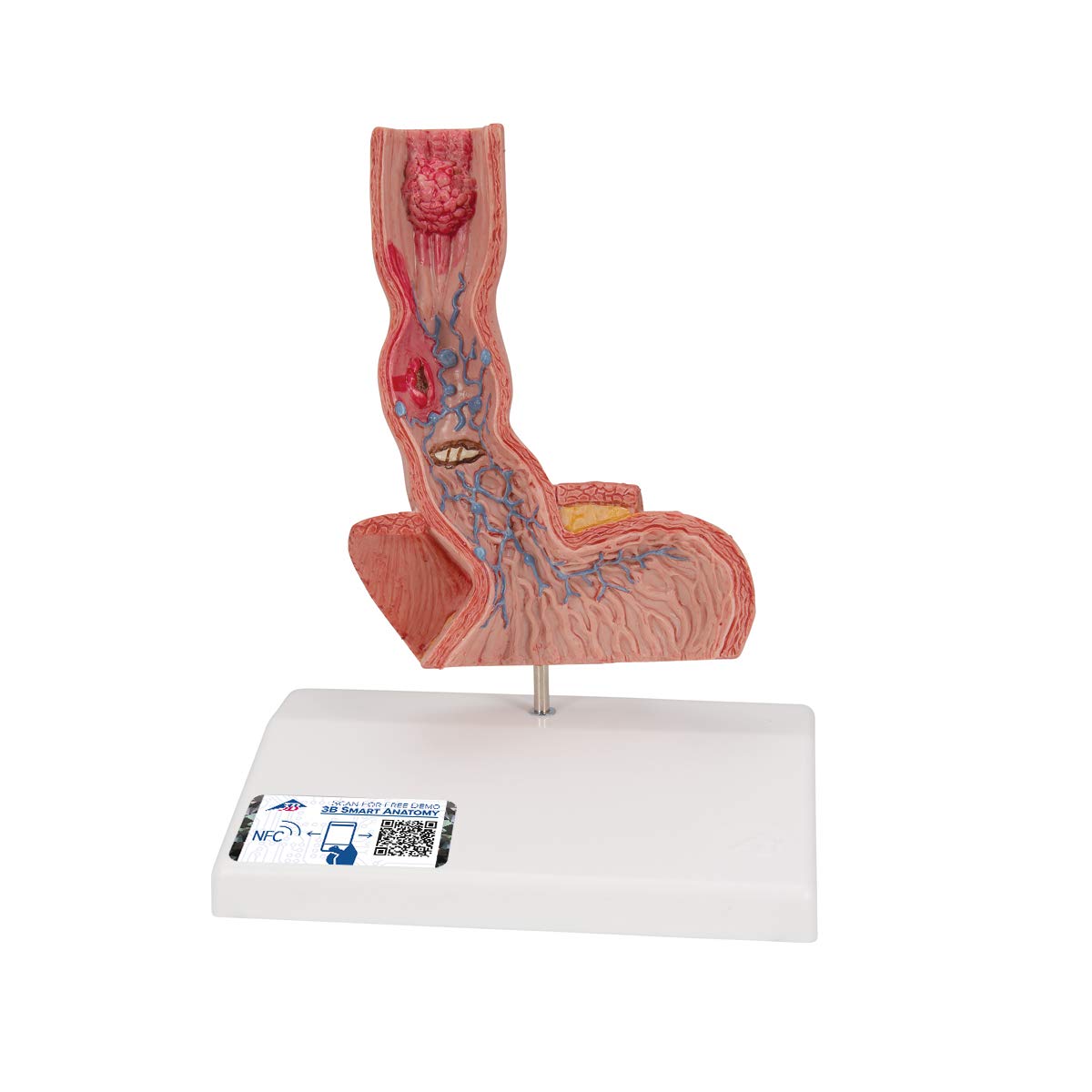 3B Scientific K18 Enfermedades del esófago – 3B Smart Anatomy