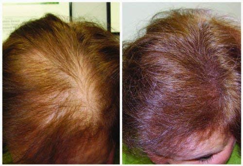 Miracle Plus Champú de cabello grueso para cabello fino para hombres y mujeres, 8 onzas.