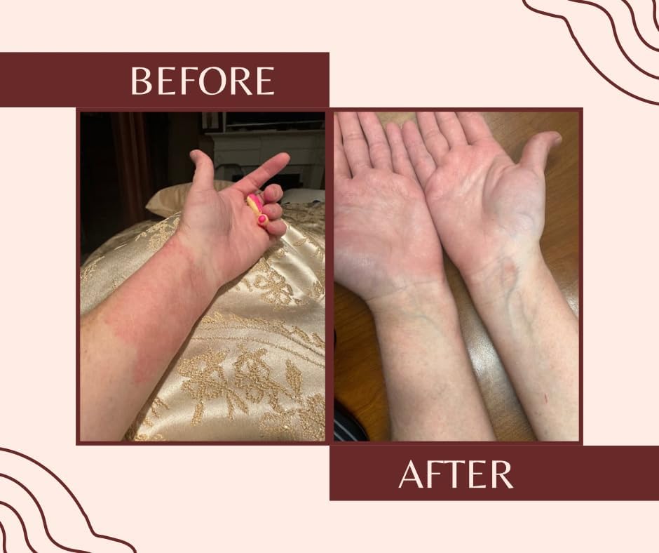 Eczema Guard -Tratamiento natural de eccema, hidratante hipoalergénico, alivio de la piel sensible, producto para el cuidado del eccema, cuidado