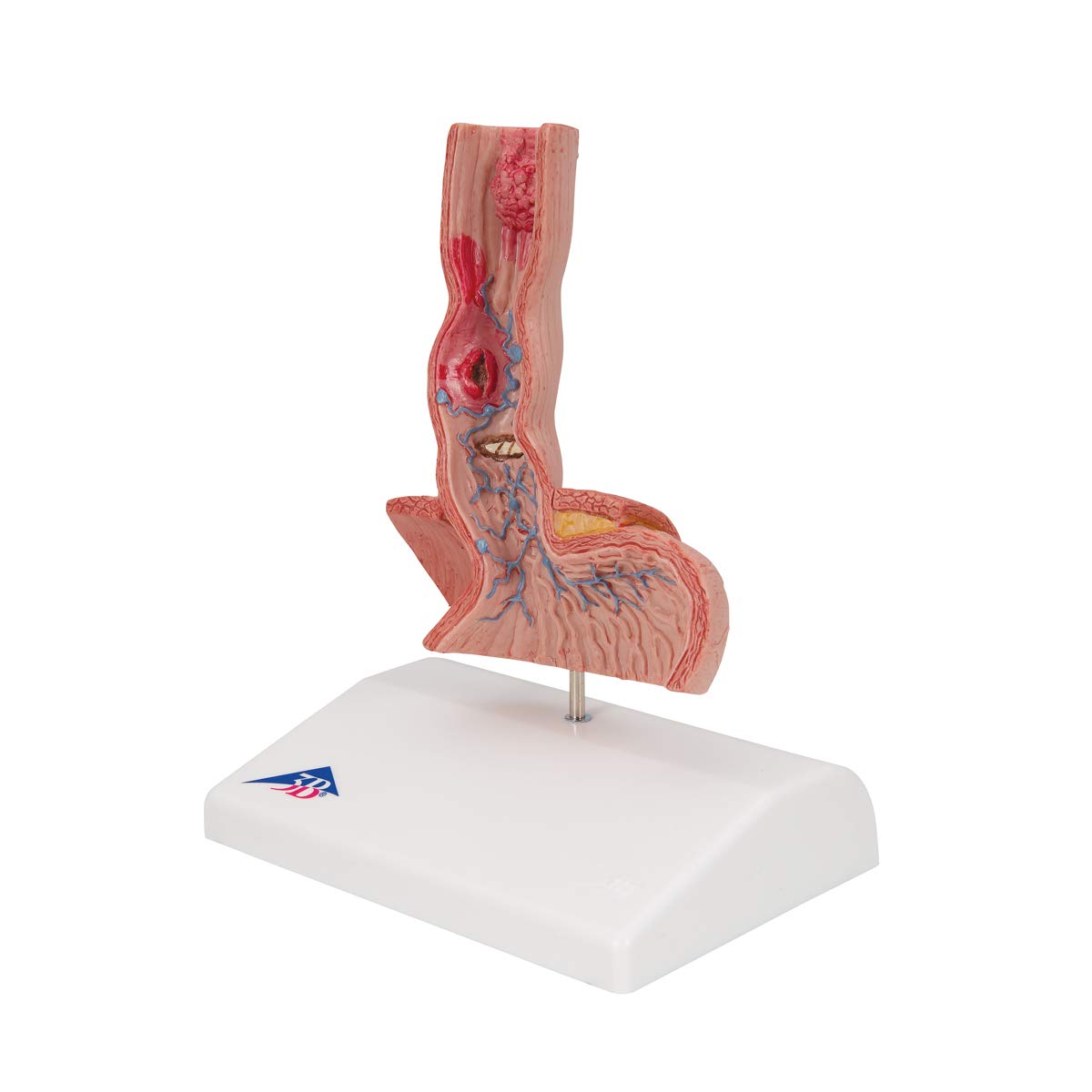 3B Scientific K18 Enfermedades del esófago – 3B Smart Anatomy
