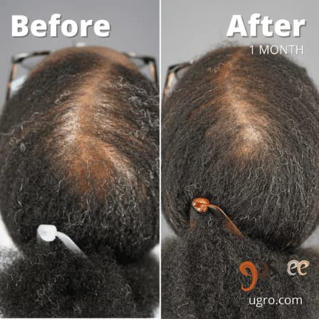 Dr.UGro Gashee Suplemento para el crecimiento del cabello para hombres y mujeres vitaminas para el cabello más grueso y fuerte. Promueve el