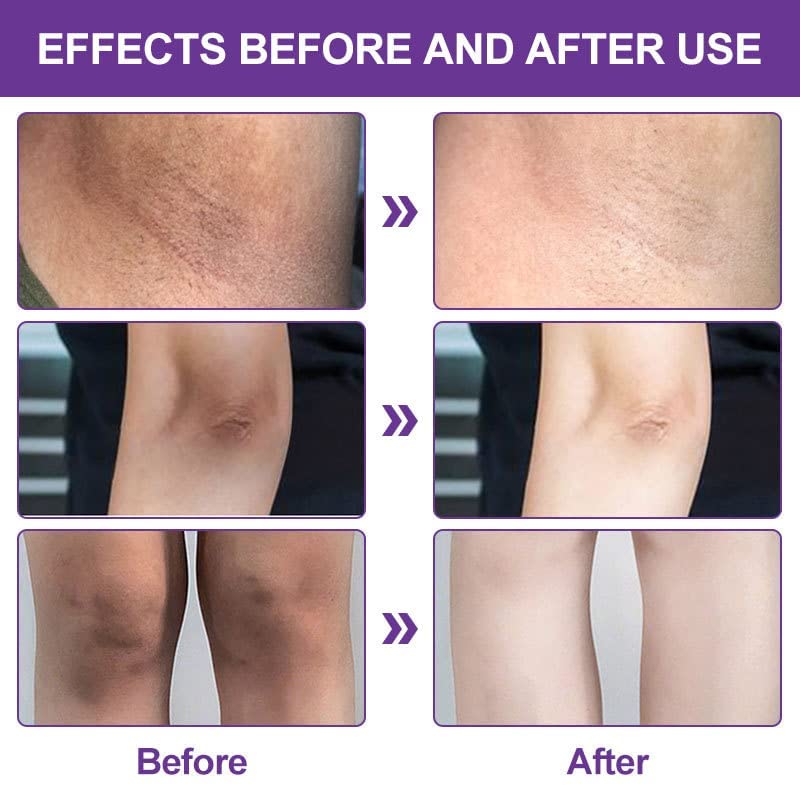 Acclyd – Crema corrector de manchas oscuras para el cuerpo, áreas íntimas, axilas, axilas, rodillas, piernas, codos y muslos internos, crema