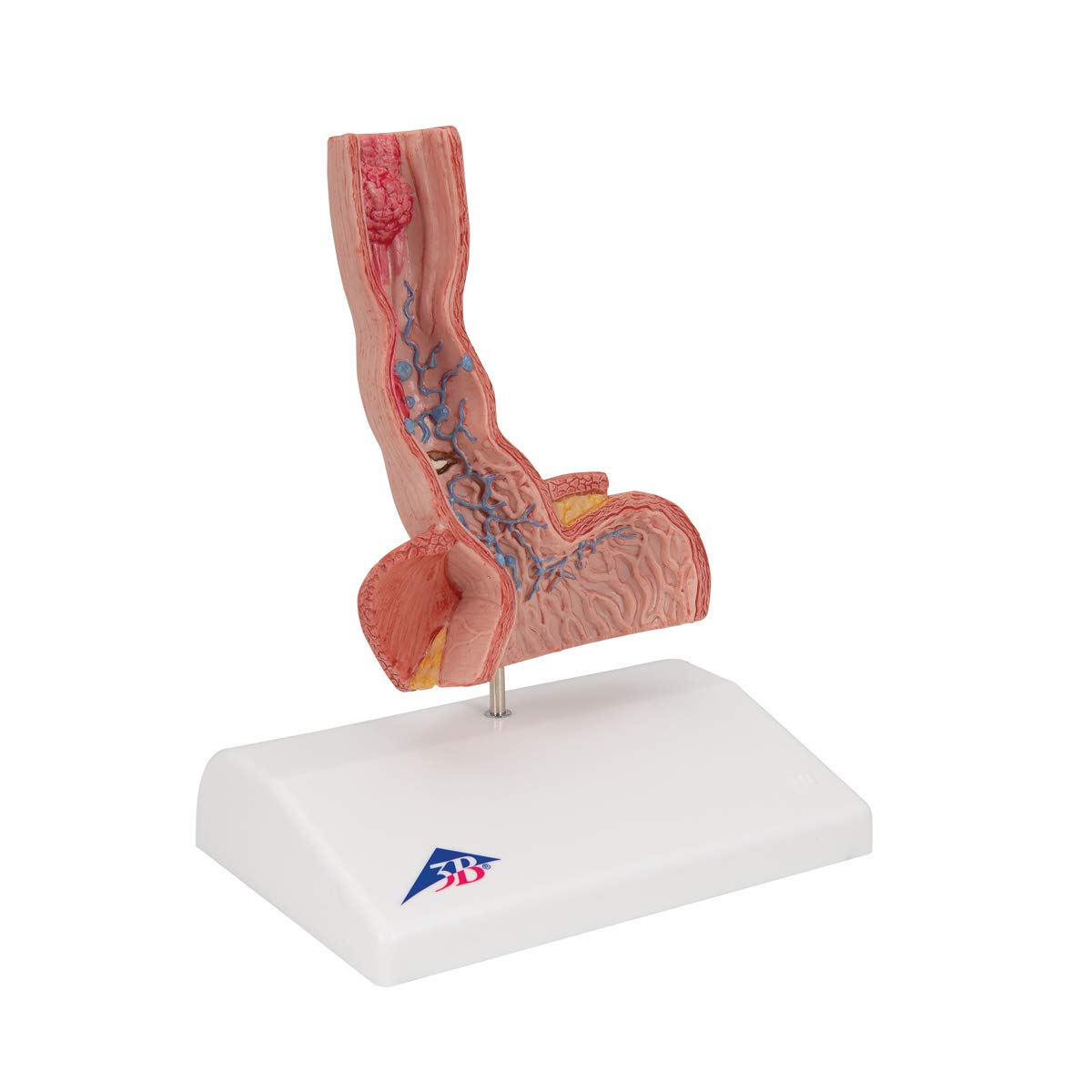 3B Scientific K18 Enfermedades del esófago – 3B Smart Anatomy