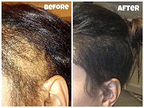 CWHaircare Set de crecimiento, el kit de iniciación de 2 piezas para el cuidado del cabello CW ayuda a hacer crecer tus bordes y coronar la espalda