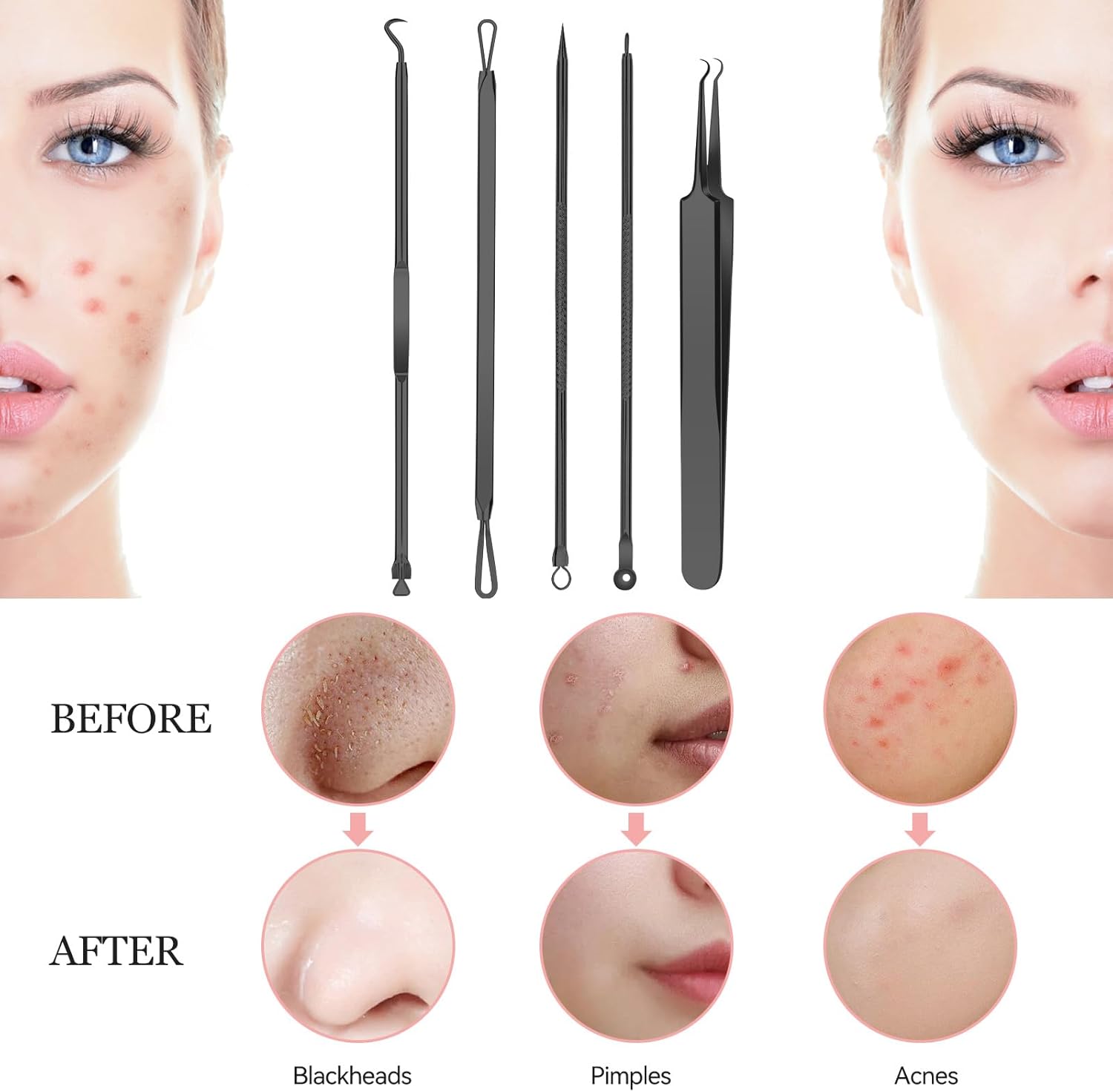 Removedor de puntos negros, 8 piezas de acero inoxidable, kit de herramientas de eliminación de manchas de puntos blancos, extractor de comedones