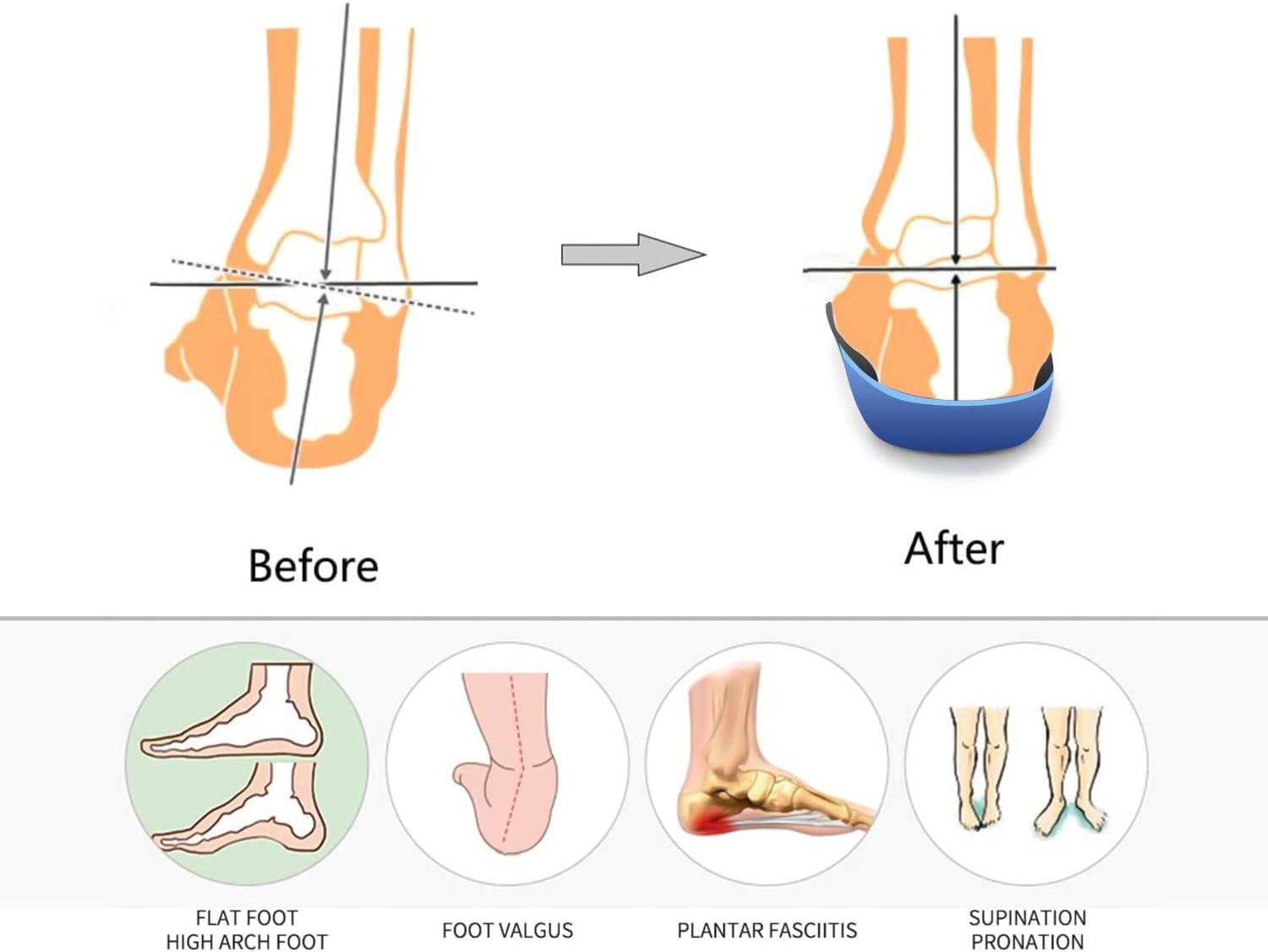 DKSUKO Plantillas ortopédicas de soporte de arco para fascitis plantar para hombres y mujeres, plantillas ortopédicas de gel para pies planos, arco