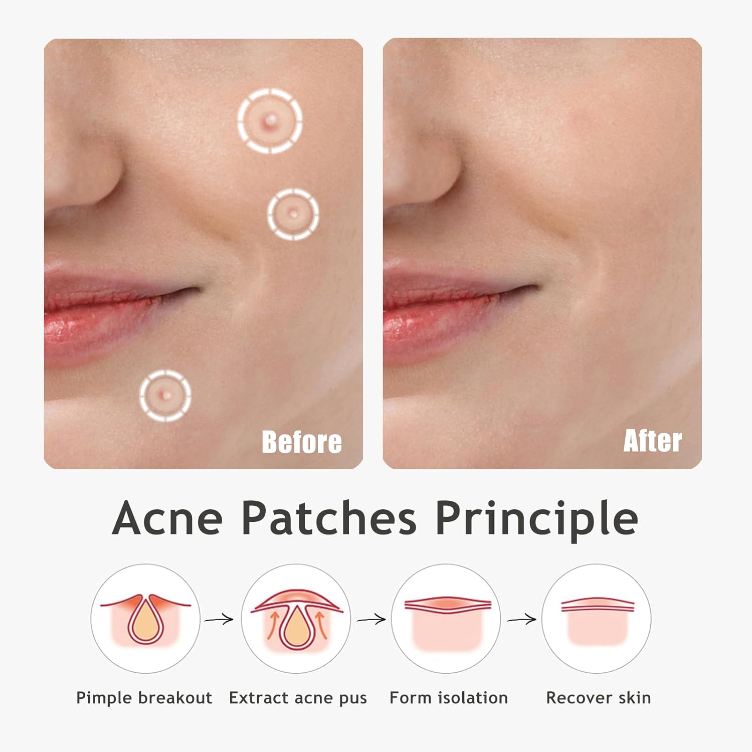 Parches de espinillas ultra  Parche hidrocoloide para el acné para cubrir zits e imperfecciones, brotes de acné, calcomanías para puntos de acné