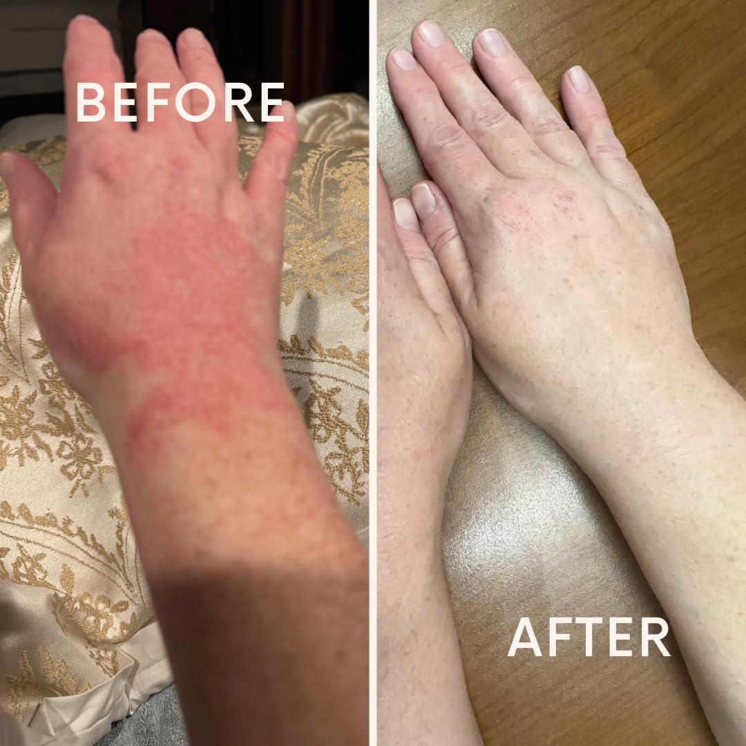 Eczema Guard -Tratamiento natural de eccema, hidratante hipoalergénico, alivio de la piel sensible, producto para el cuidado del eccema, cuidado