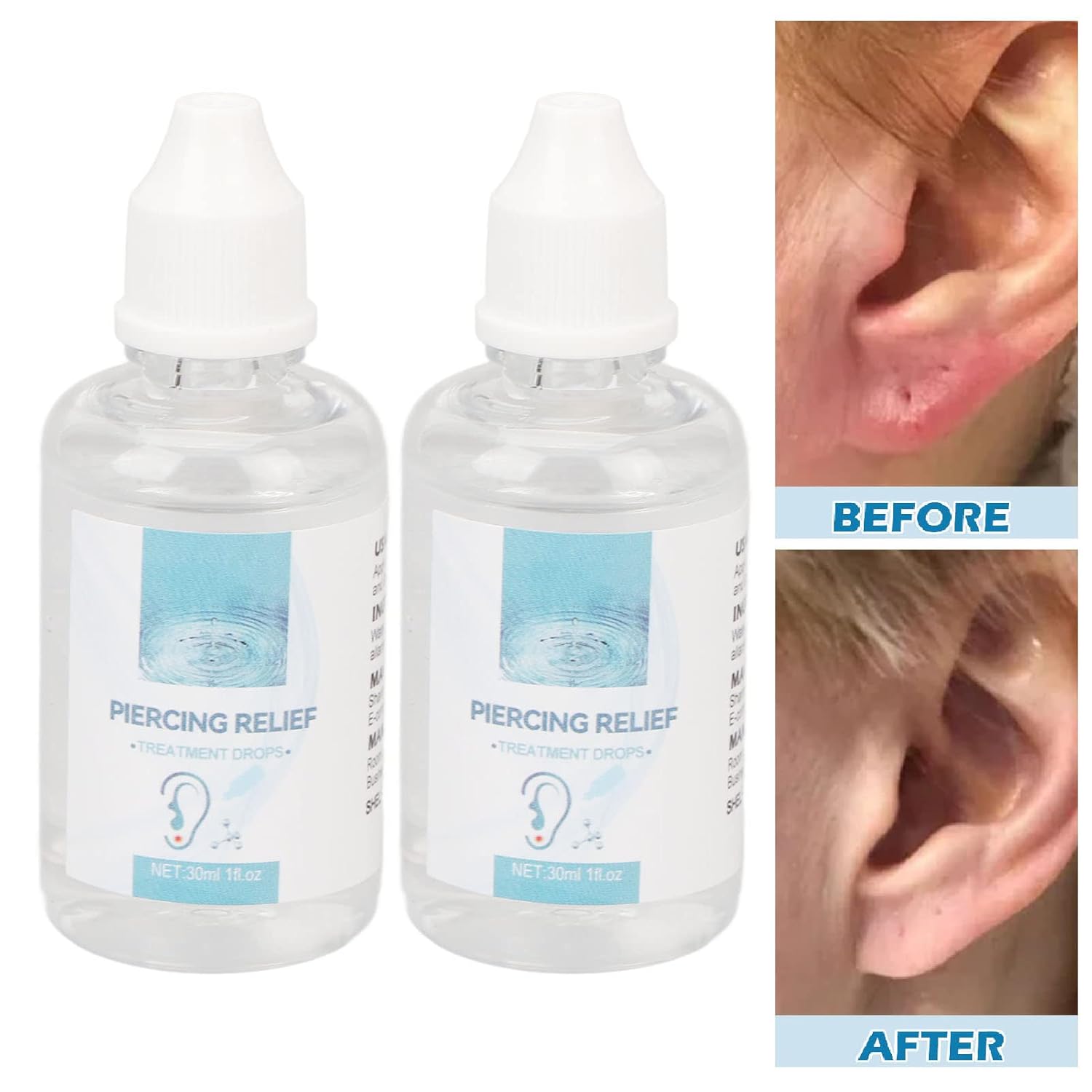 2 gotas de eliminación de queloides de 1.0 fl oz, gotas de perforación para aliviar el enrojecimiento, hinchazón, perforación de tratamiento