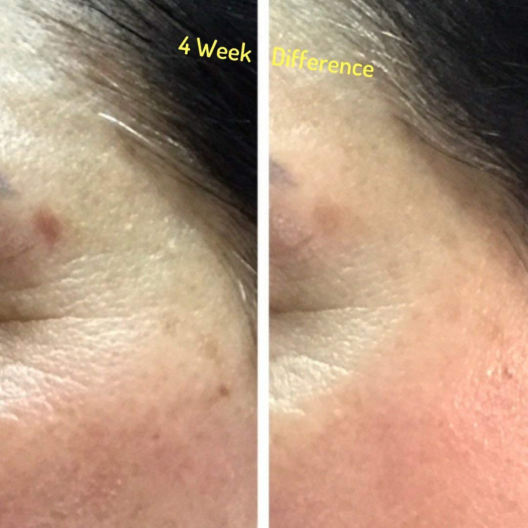 Gel corrector de manchas oscuras íntimas para cuerpo, bikini y áreas sensibles con crema removedor corrector de manchas oscuras