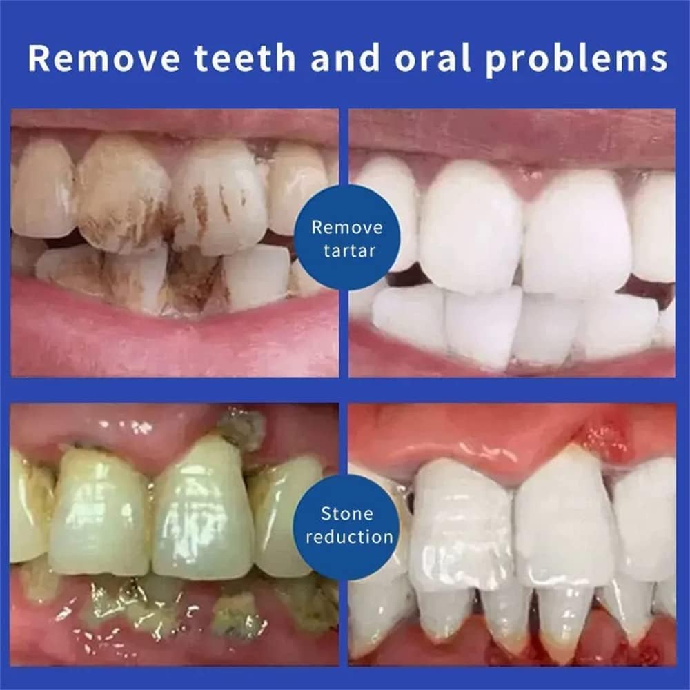 Pasta de dientes blanqueadora SP-4 Probióticos, pasta de dientes Yayashi SP-4, pasta de dientes de aliento fresco, promueve dientes y encías