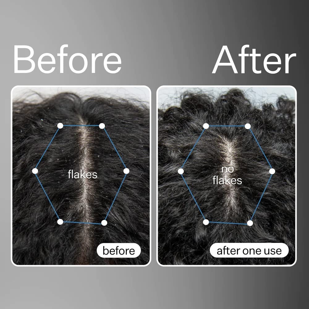 ACT+ ACRE Suero de células madre procesadas en frío y cápsulas de cabello grueso y completo y aceite de desintoxicación del cuero cabelludo,