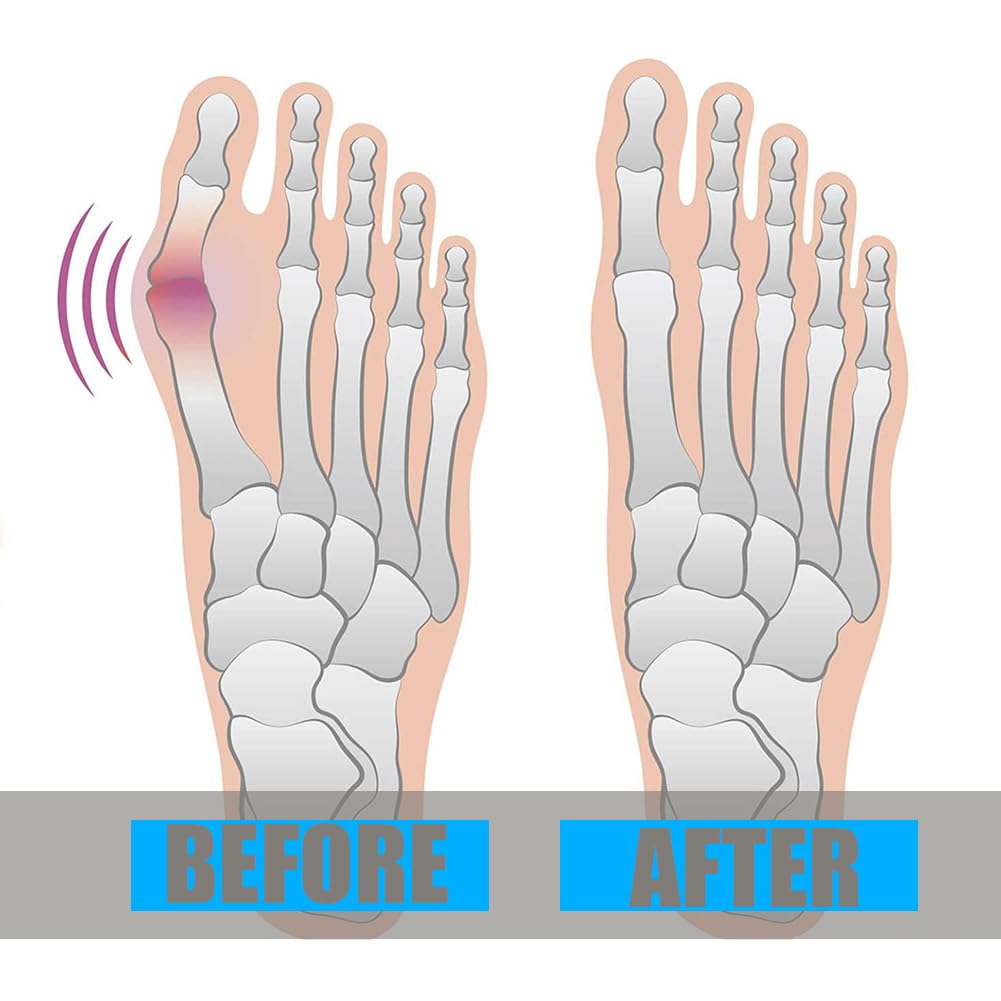 Corrector de juanetes para mujeres y hombres, corrector de hallux valgus, protector de férula para aliviar el dolor (1 par)