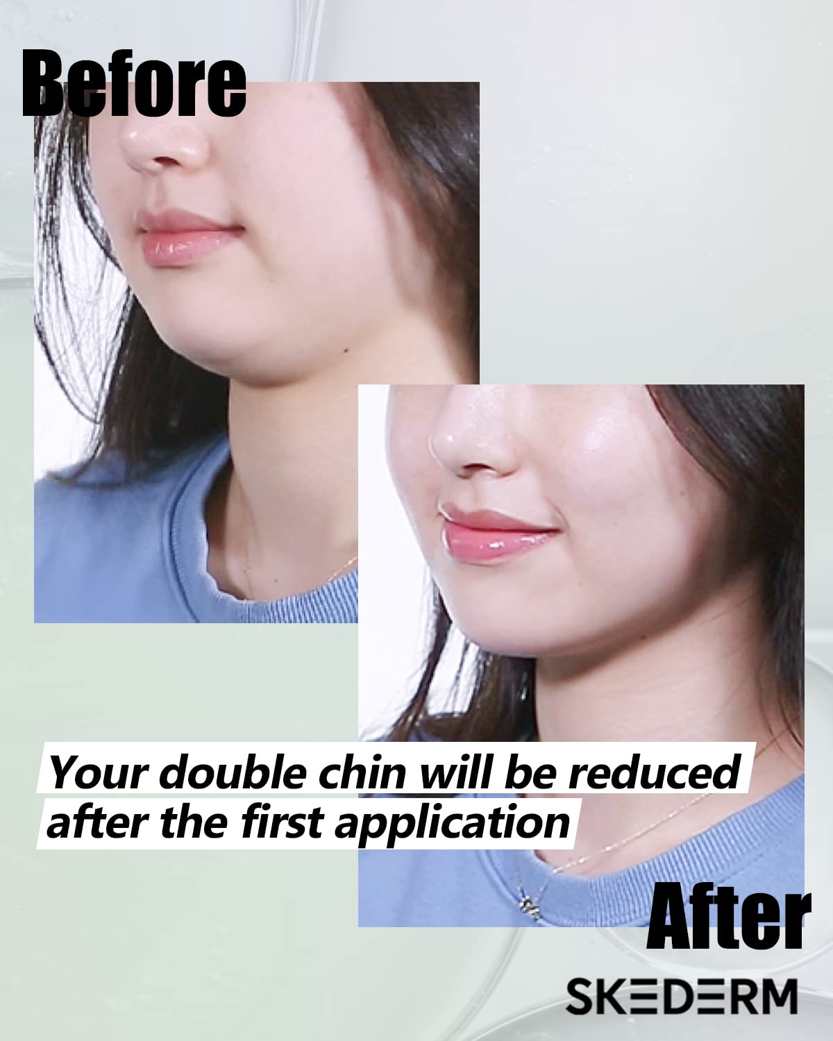 SKEDERM Parche de elevación Hyaluron  Máscara facial adelgazante en forma de V Reductor de barbilla doble Máscara de elevación de línea V