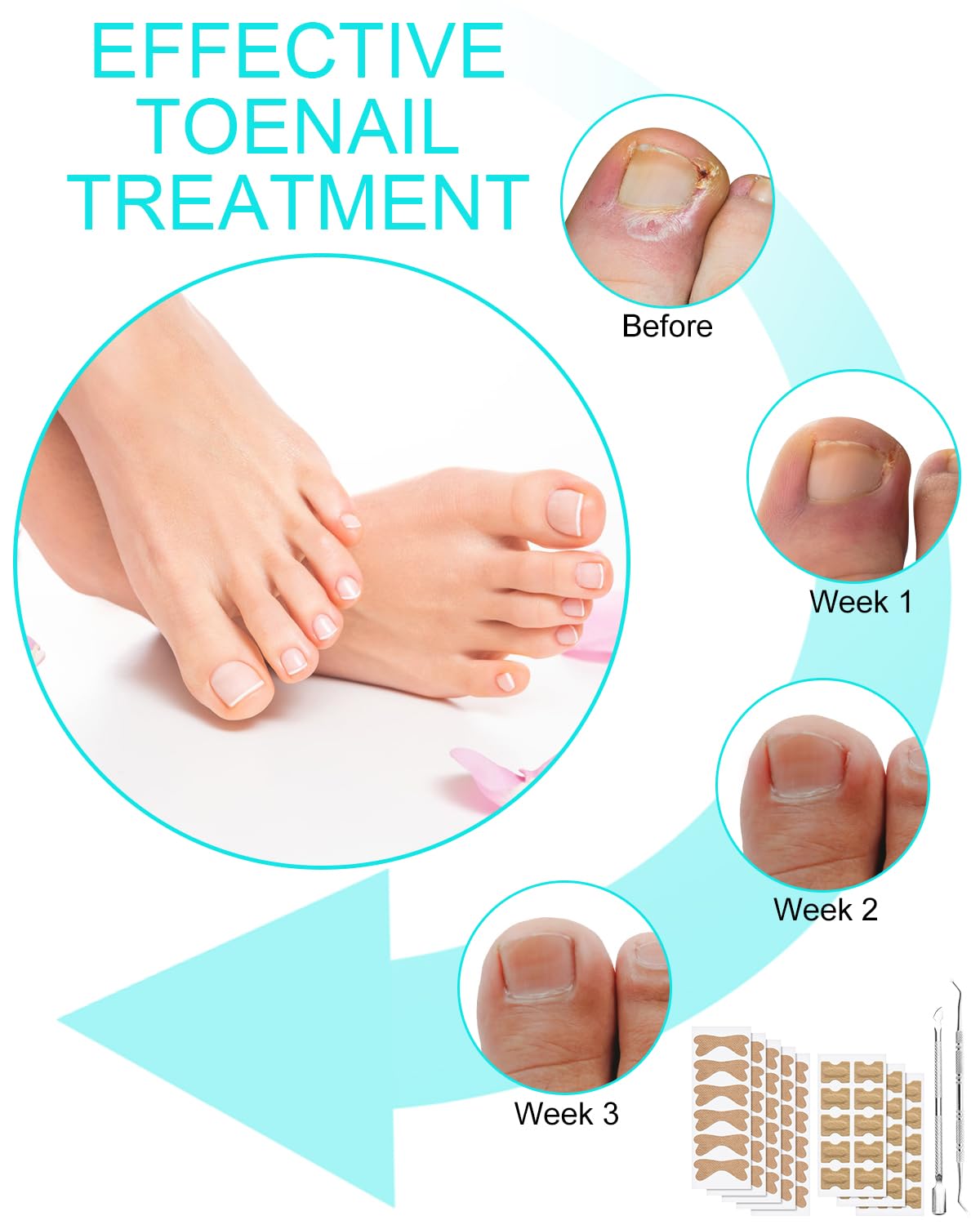 Herramienta de tratamiento de corrección de uñas encarnadas, 60 parches correctores de uñas encarnadas en 2 tipos, herramienta profesional segura