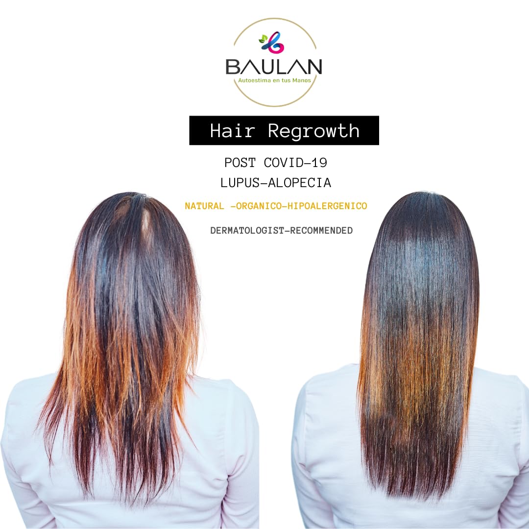 BAULAN-CONTROL DE LA PÉRDIDA DE CABELLO TRATAMIENTO DE ACONDICIONAMIENTO POST COVID 19-LUPUS-ALOPECIA
