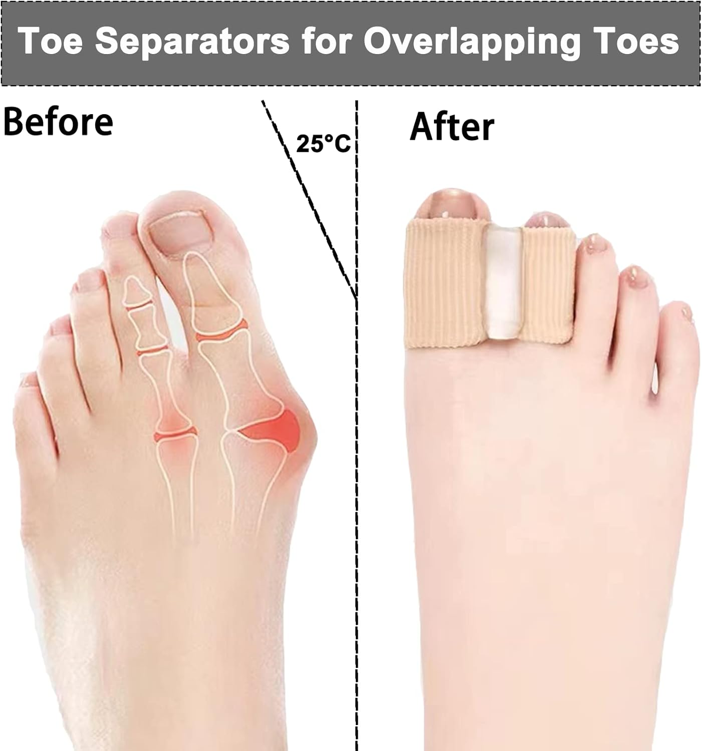 12 paquetes de separadores de dedos de gel para dedos superpuestos, espaciadores de dedos para juanetes para mujeres y hombres, 2 bucles corrector