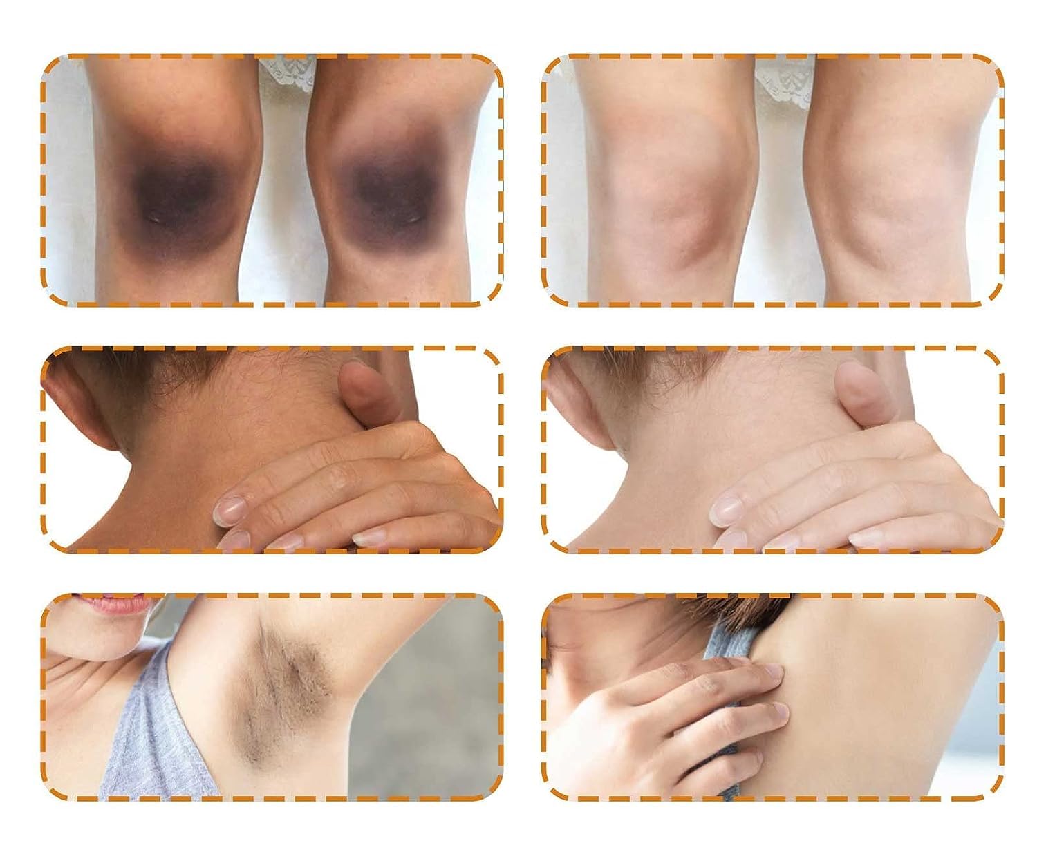Acclyd – Crema corrector de manchas oscuras para el cuerpo, áreas íntimas, axilas, axilas, rodillas, piernas, codos y muslos internos, crema
