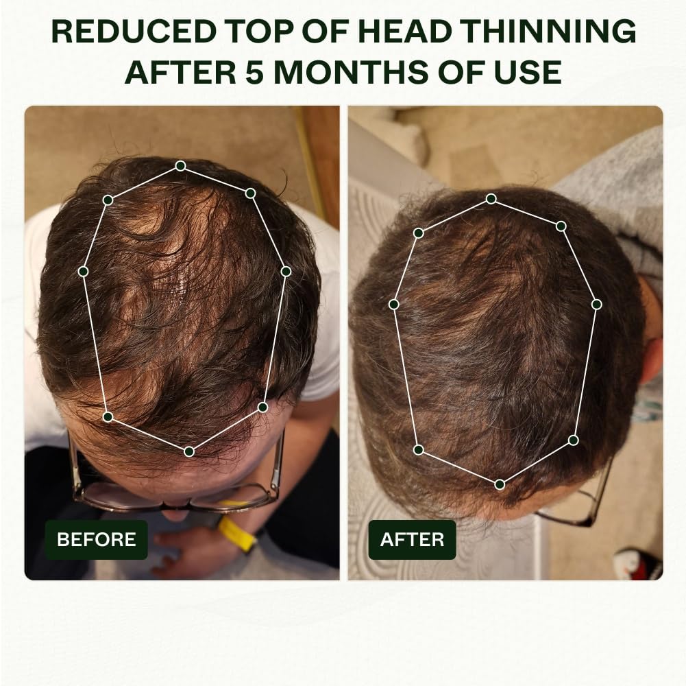 Rutina de activación capilar de 3 pasos para hombres, clínicamente probada con resultados en 45 días una fórmula de pérdida de cabello respaldada
