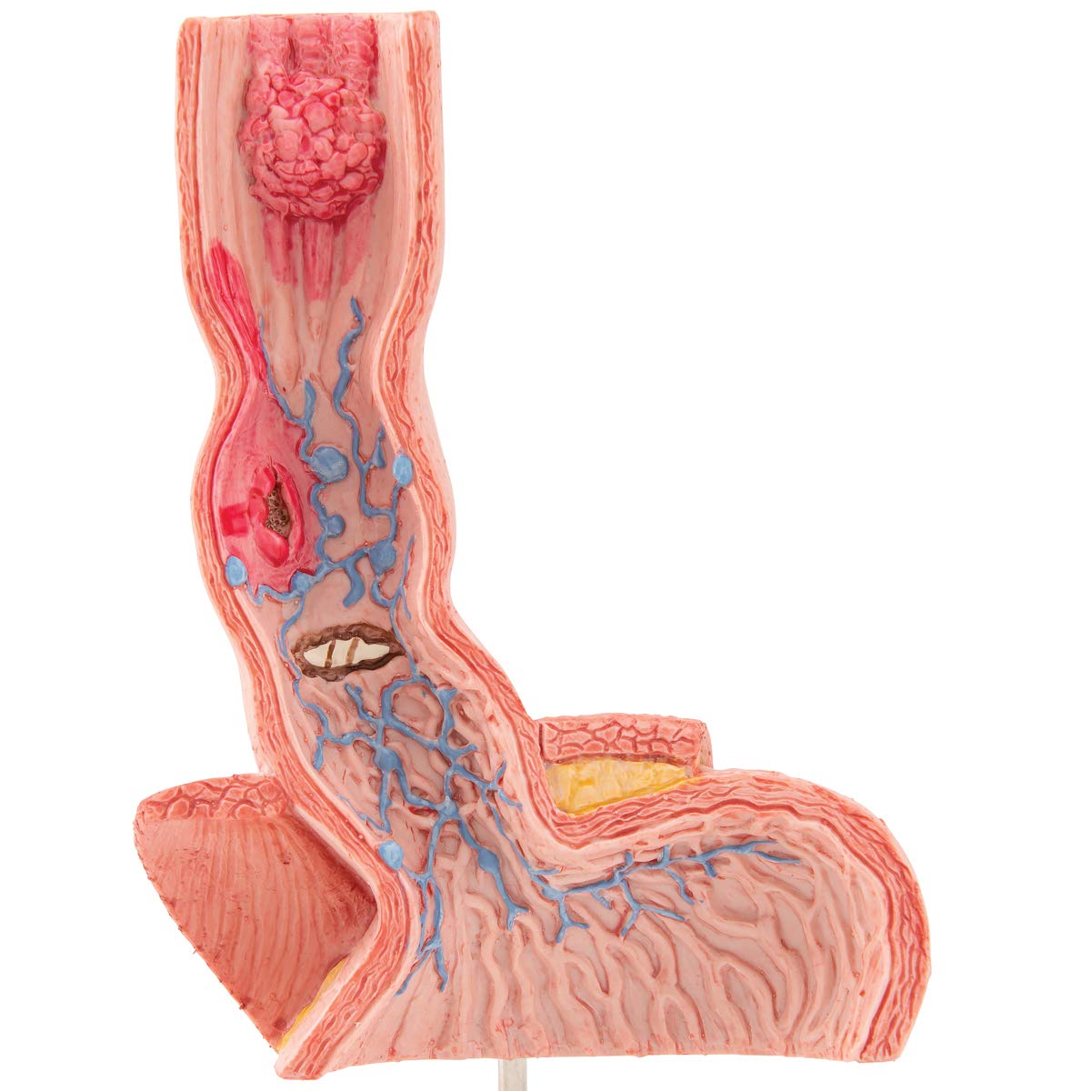 3B Scientific K18 Enfermedades del esófago – 3B Smart Anatomy