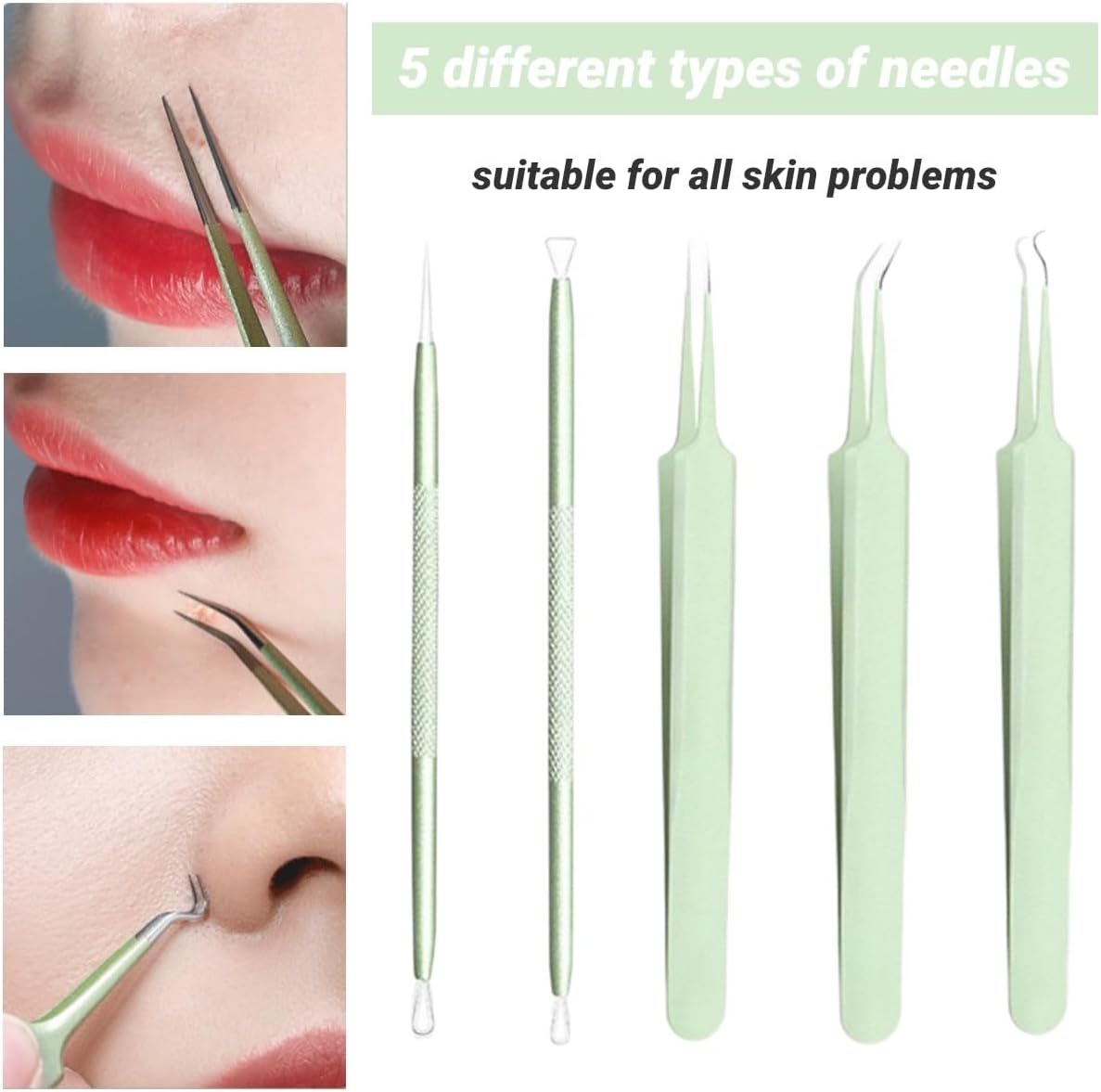 BIVIZKU Kit de herramientas para eliminar puntos negros, kit de 5 piezas, kit profesional de eliminación de acné de acero inoxidable para nariz y