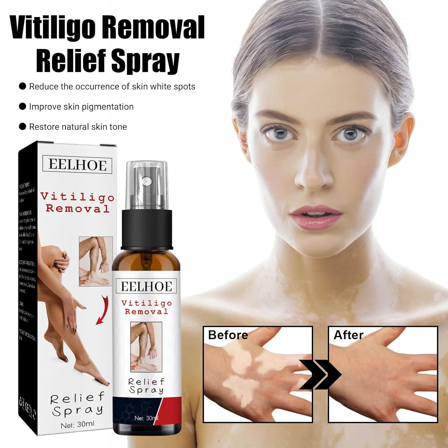 NYYQYYN EELHOE – Spray de alivio de vitiligo de manchas blancas, spray de reparación de la piel de vitiligo, spray para el cuidado de la piel,
