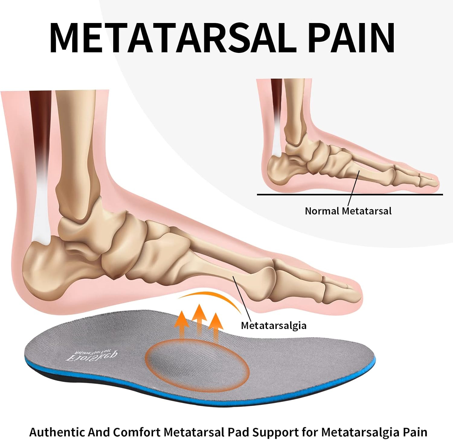 FiotSkep Almohadilla metatarsiana de arco alto para neuroma de Morton, insertos de dolor de bola de pie, fascitis plantar, pies planos, espuma