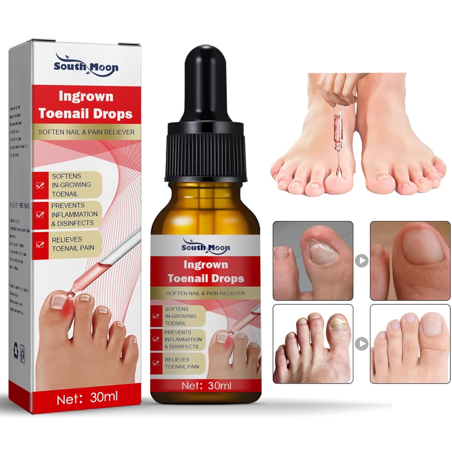 Uñas encarnadas Tr-e a t-me-nt-30ML1 fl oz encarnadas para uñas encarnadas, kit R-e-mo-val para uñas encarnadas para un fácil recorte, herramientas