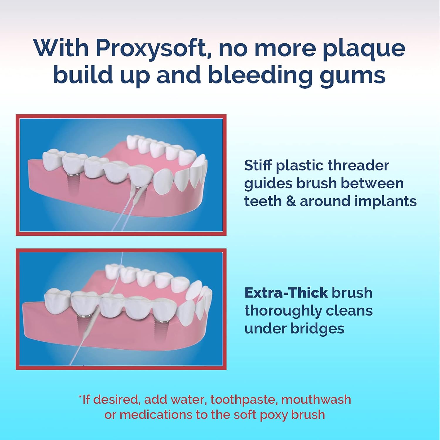 Proxysoft Hilo dental para puentes e implantes 12 paquetes  Enhebradores de hilo dental para puentes, implantes dentales, aparatos ortopédicos con