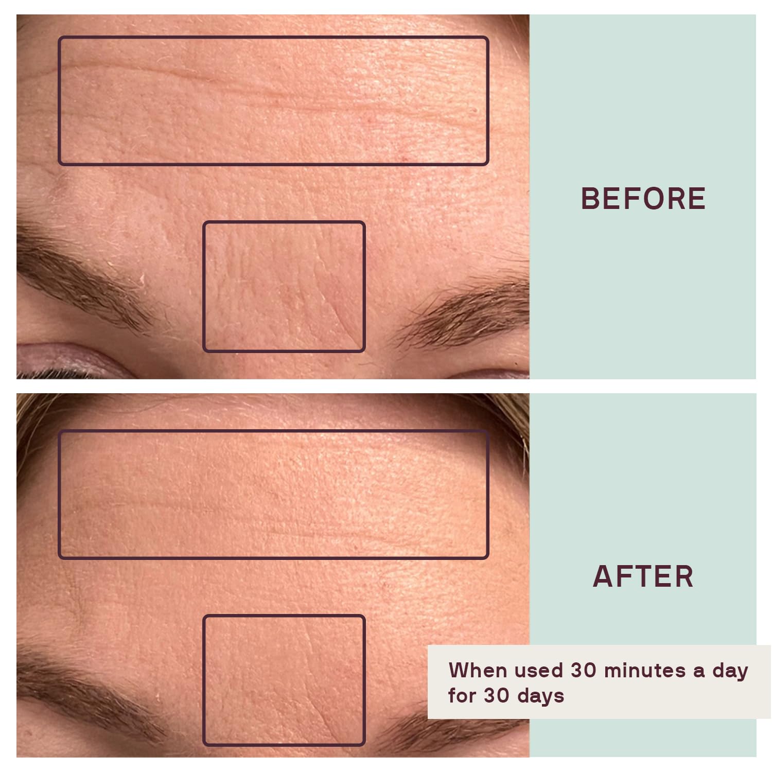 Dermaclara Kit de parches faciales  Parches antiarrugas para frente, líneas de sonrisa, tratamiento de línea de fruncido antiarrugas de silicona,