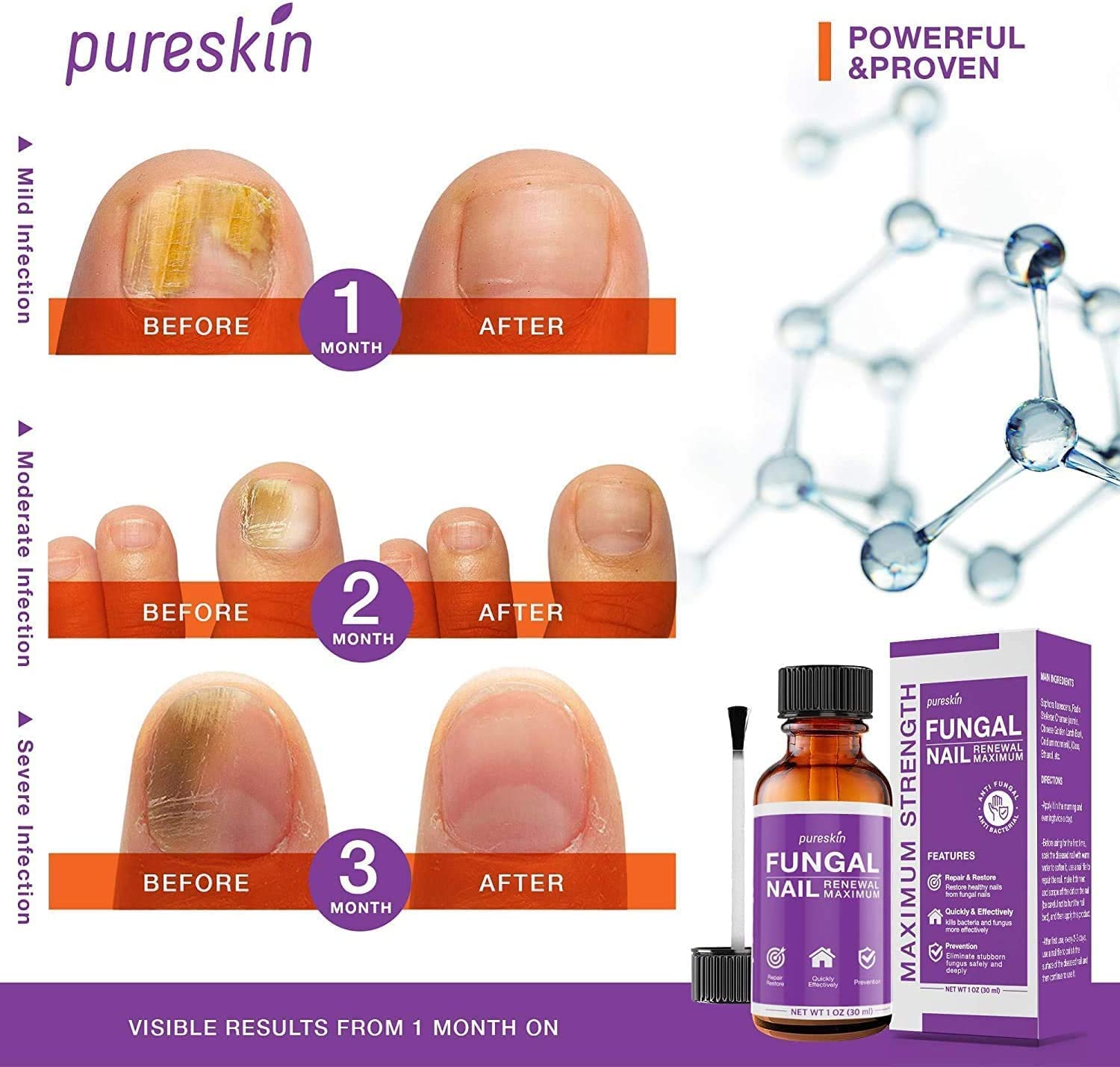 Tratamiento de hongos en las uñas de los pies y las uñas finas, tratamiento de hongos en las uñas de los pies, extra fuerte, tratamiento eficaz de