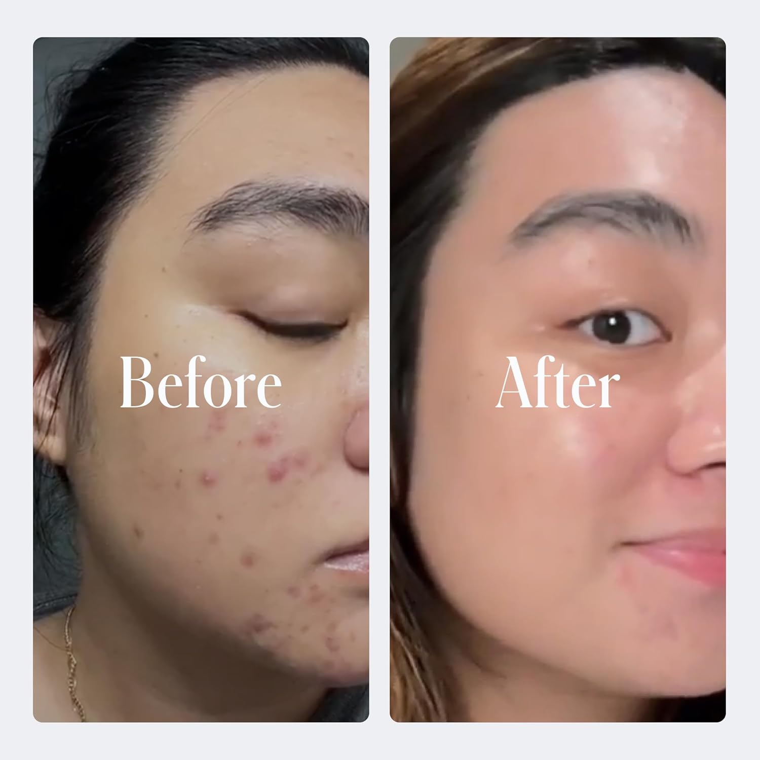 Geologie Sensitive Complete – Juego de cuidado de la piel de 5 piezas para 90 días, acné, aceite, manchas oscuras, lavado facial con ácido