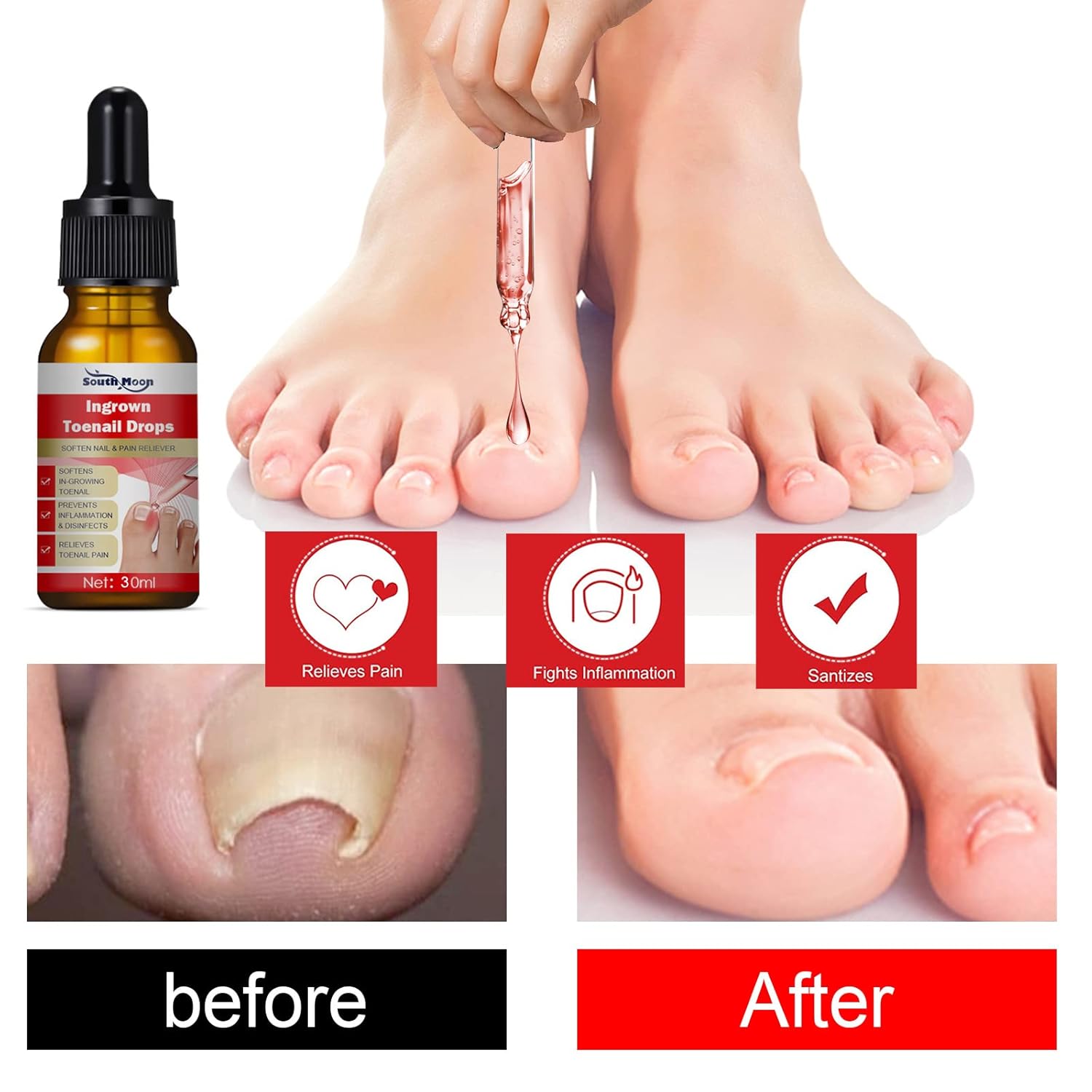 Uñas encarnadas Tr-e a t-me-nt-30ML1 fl oz encarnadas para uñas encarnadas, kit R-e-mo-val para uñas encarnadas para un fácil recorte, herramientas