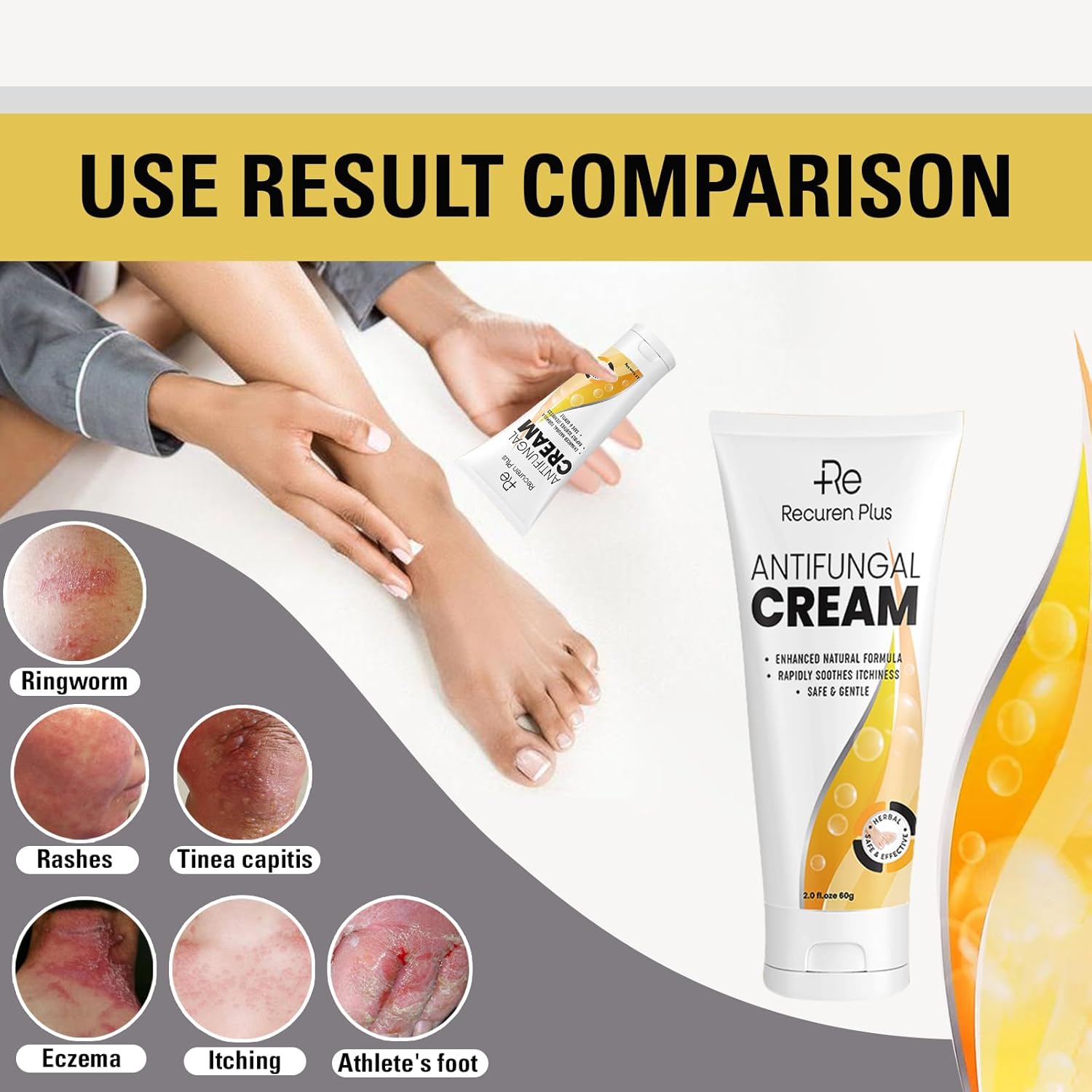 Crema antifúngica Tratamiento de pies de atletas – Tratamiento Versicolor de tiña – Crema de comezón jock – Tratamiento de pies de atletas extra