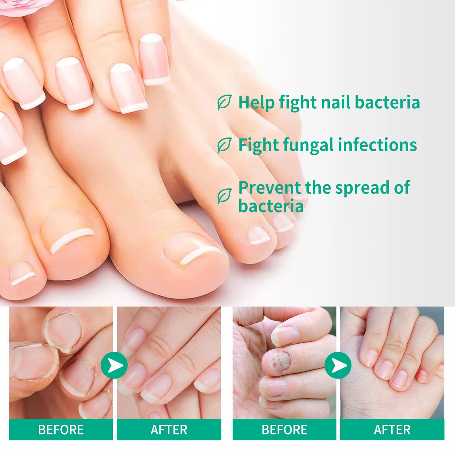 Paquete de 2 unidades de tratamiento de uñas de metanail tratamiento de crecimiento de uñas para tratamiento de uñas de los pies, extra fuerte para