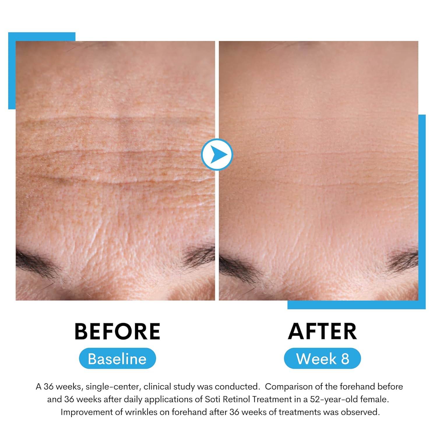 Suero de retinol para cara al 2.5% con niacinamida, ácido hialurónico y vitamina E. Suero facial antienvejecimiento para líneas, arrugas, manchas de