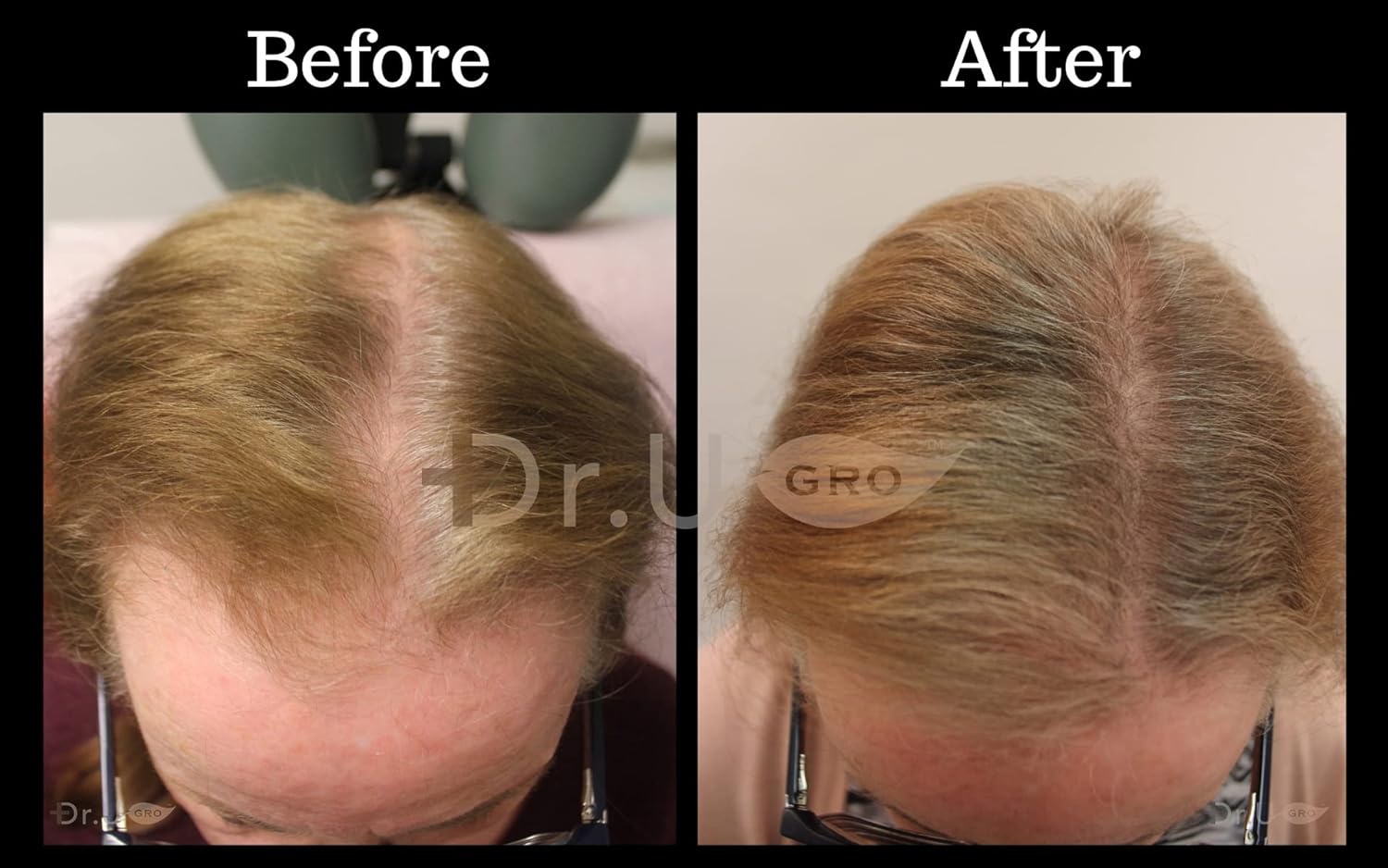 Dr.UGro Gashee Suplemento para el crecimiento del cabello para hombres y mujeres vitaminas para el cabello más grueso y fuerte. Promueve el