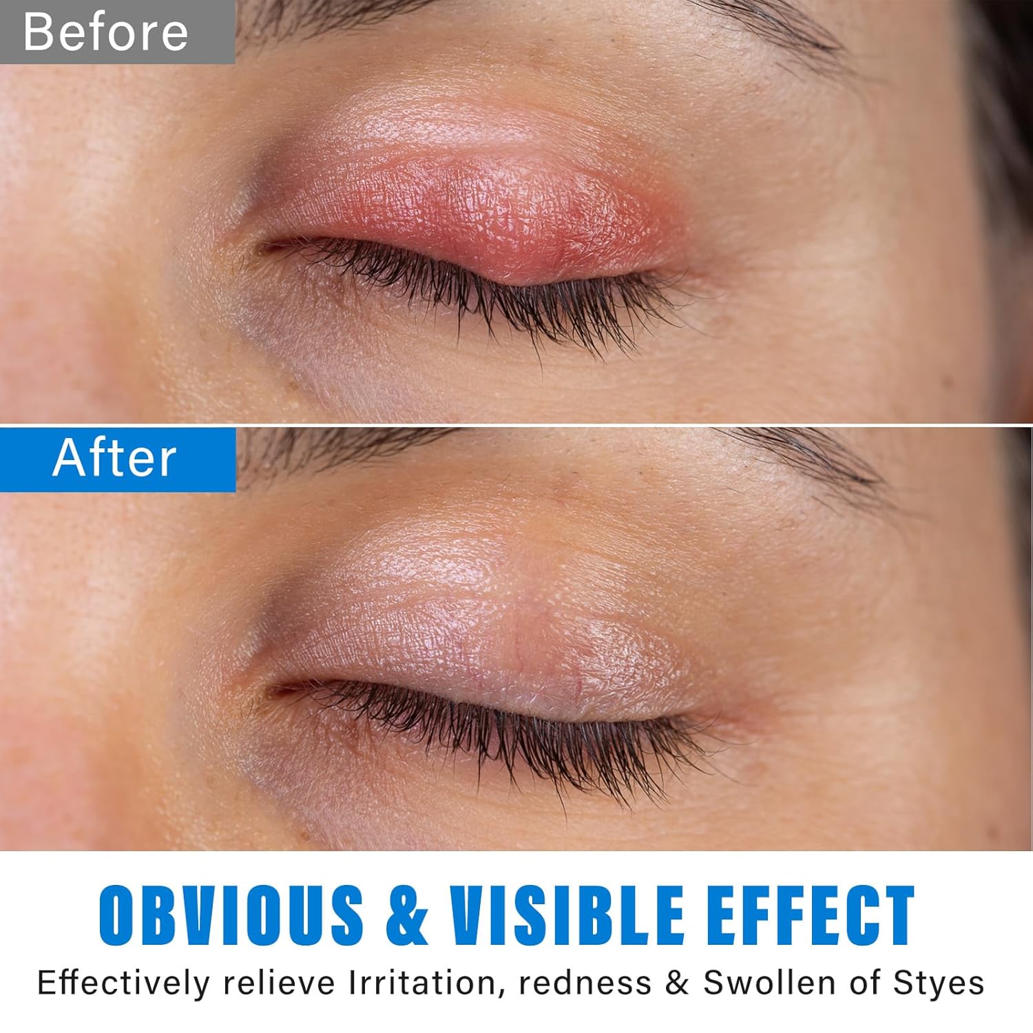 VERYCOZY Tratamiento de ojos de orzuelo, alivio eficiente para los ojos de orzuelo para tratamiento de blefaritis y calazión, suero de alivio de