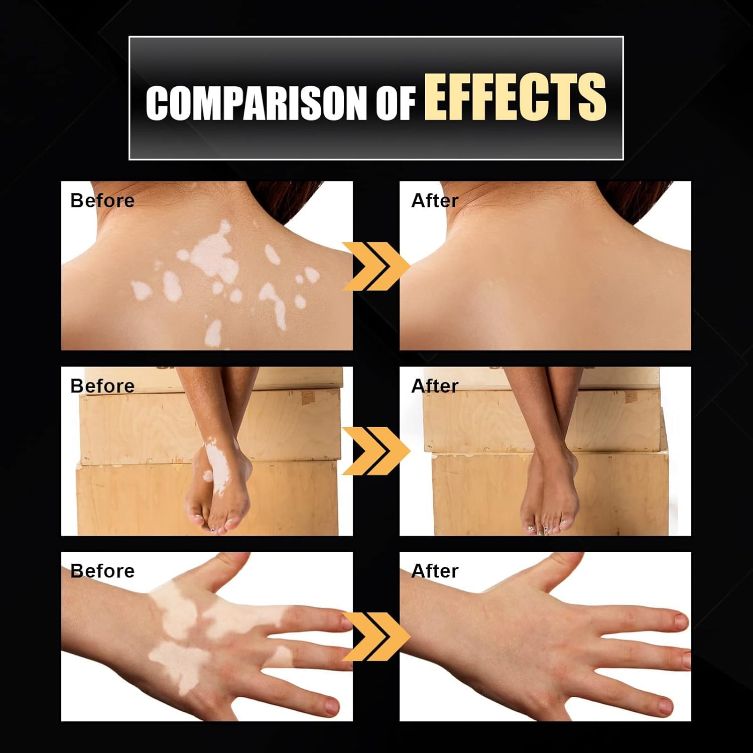 NYYQYYN EELHOE – Spray de alivio de vitiligo de manchas blancas, spray de reparación de la piel de vitiligo, spray para el cuidado de la piel,