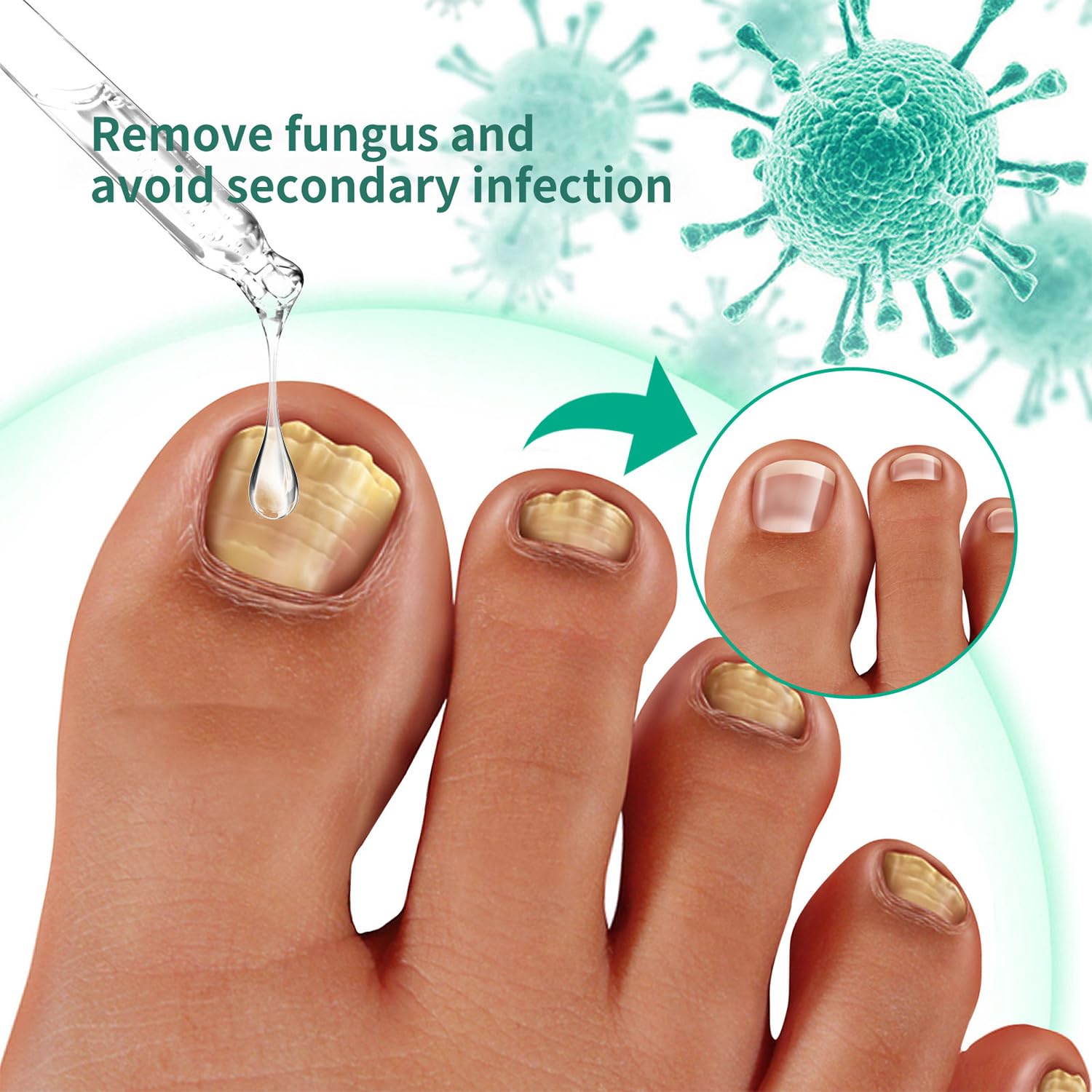Tratamiento de uñas de metanail, tratamiento de crecimiento de uñas para tratamiento de uñas de los pies, extra fuerte para reparar uñas dañadas y