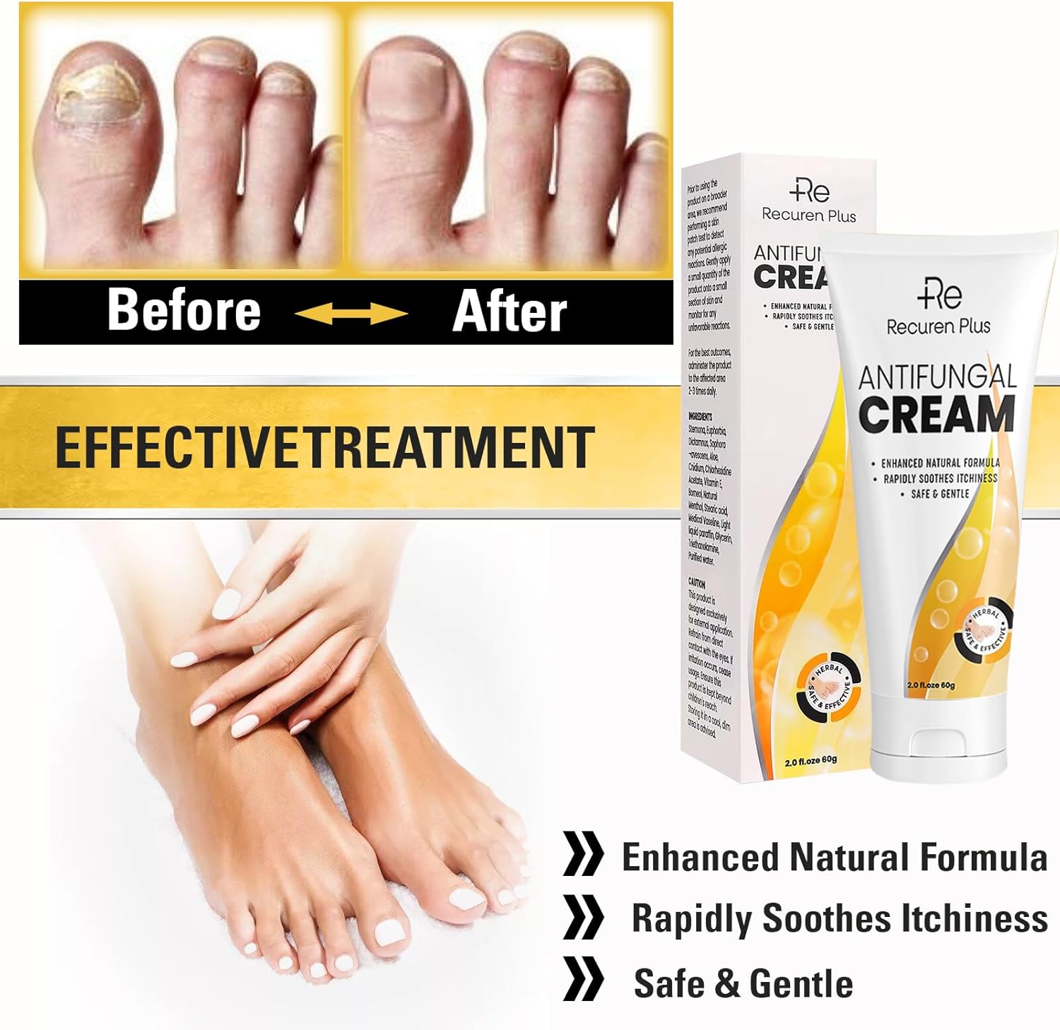 Crema antifúngica Tratamiento de pies de atletas – Tratamiento Versicolor de tiña – Crema de comezón jock – Tratamiento de pies de atletas extra